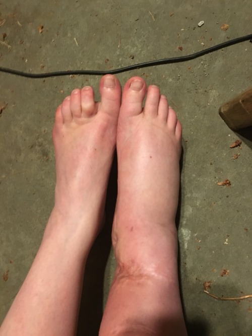 iamatinyowl:  iamatinyowl:  This is what I’m dealing with right now. My entire foot is so itchy because of how swollen it is the skin is pulled so tight :(     IT IS SO MUCH WORSE TODAY   Rub your vagina on it or vagina of a friend, a transgender woman’s