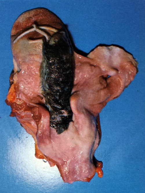 Bolus death in a schizophrenic patient. Note the mouse located in the oropharynx causing the airway 