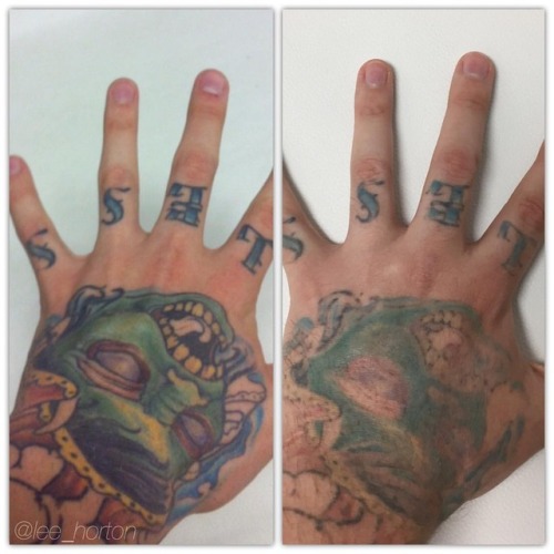 Seeing some good progress after 3 #tattooremoval treatments on my own hand. #forestcityroots #tattoo