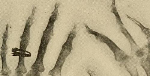 Diseases of bones and joints, 1914
