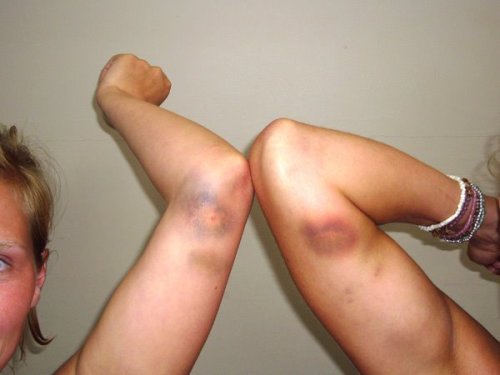 b-ruisedblood:  bruisesandbeauty: surfing injuries   all about bruises