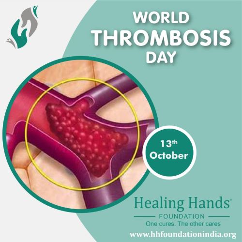 WHAT IS THROMBOSIS?

Thrombosis is the formation or presence of a blood clot in a blood vessel. The vessel may be any vein or artery as, for example, in a deep vein thrombosis or a coronary (artery) thrombosis. The clot itself is termed a thrombus. If the clot breaks loose and travels through the bloodstream, it is a thromboembolism
The most common of all is Venous Thromboembolism (VTE).For those who do not know, Venous Thromboembolism (VTE) is dangerous, which causes blood clots to be formed deep in veins of leg, groin or arm. The clot then may travel causing a blockage in lungs(pulmonary embolism).
Deep vein thrombosis or DVT, is a blood clot that forms in a vein deep in the body. Blood clots occur when something slows or changes the blood flow. Blood thickens and clumps together.
Most deep vein blood clots occur in the lower leg or thigh, however, they can also occur in other parts of the body such as the groin and arms.
A blood clot in a deep vein can break off and travel through the bloodstream. The loose clot is called an embolus. It can travel to an artery in the lungs and block blood flow. This condition is called pulmonary embolism, or PE, a very serious condition. Remember, DVT + PE = VTE.
These two conditions together can be very dangerous, potentially deadly medical condition. It hinders normal blood flow in body interrupting the circulatory system.The international campaigns work towards seeking global spotlight on thrombosis as an urgent and growing health condition. 

SYMPTOMS, SIGNS &PREVENTION in comment section👇


#bloodclots #dvt #worldthrombosisday #bloodclot #thrombosisawareness #knowthrombosis #fissuré #bhfyp #vte #medicine #pulmonaryembolism #trombosis #angiolog #deepveinthrombosisawareness #healthylifestyle #surgery #health #wtday #stoptheclot #trombosi #doctor #worldthrombosisdayitaly #medical #science #trombose #vein #wtd #wtditaly #vascular #onecurestheothercare  (at India,Pune)
https://www.instagram.com/p/CU9QVVyB1Yv/?utm_medium=tumblr #bloodclots#dvt#worldthrombosisday#bloodclot#thrombosisawareness#knowthrombosis#fissuré#bhfyp#vte#medicine#pulmonaryembolism#trombosis#angiolog#deepveinthrombosisawareness#healthylifestyle#surgery#health#wtday#stoptheclot#trombosi#doctor#worldthrombosisdayitaly#medical#science#trombose#vein#wtd#wtditaly#vascular#onecurestheothercare