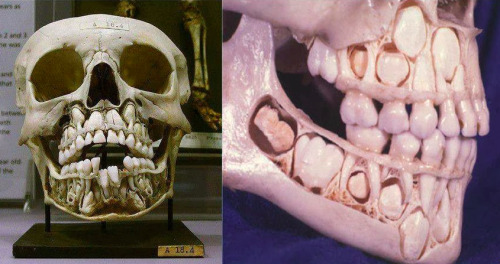 syldoran: medicalschool: A child’s skull prior to loosing its baby teeth children are terrifyi