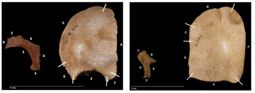 theolduvaigorge: Alterations of skull bones found in anencephalic skeletons from an identified 