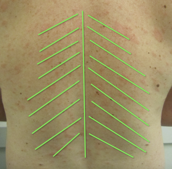 pityriasis rosea christmas tree pattern