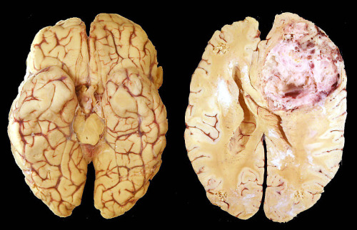 Italian scientists unravel brain tumour growth process.Scientists have discovered the mechanism that