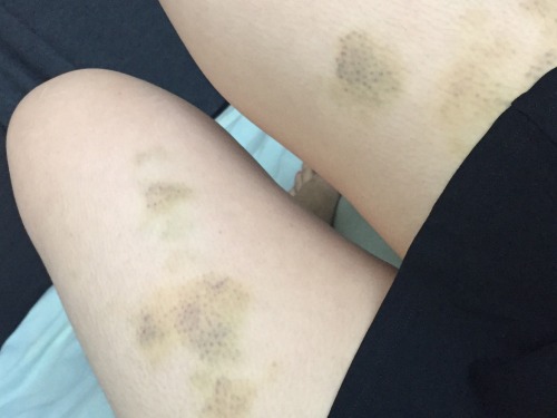 kneehighsandlows: Healing. Love marks