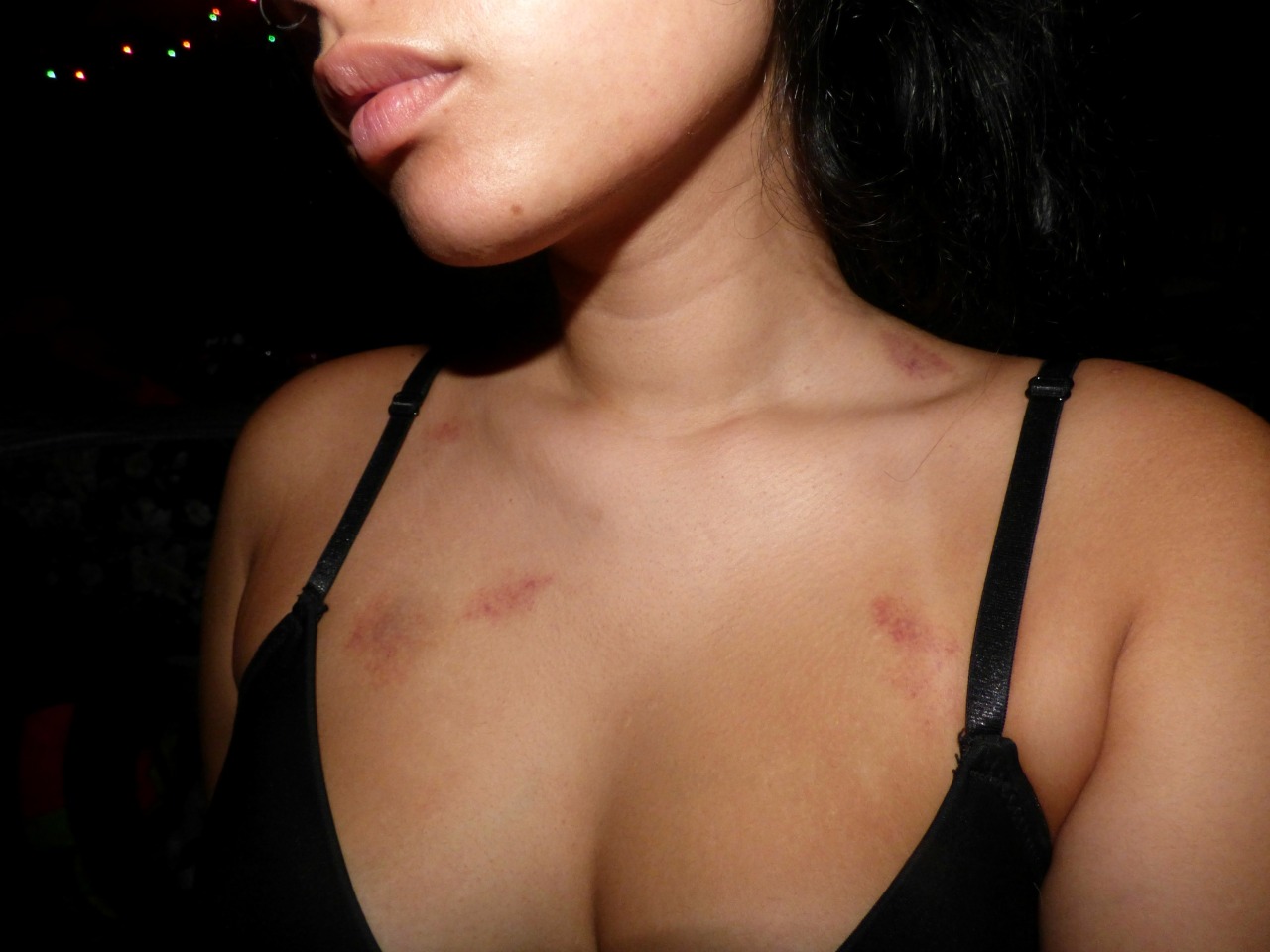 Hickies bad are why What IS
