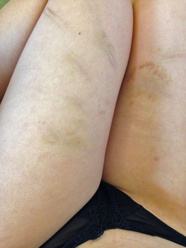 koto-bdsm:  9 days later 