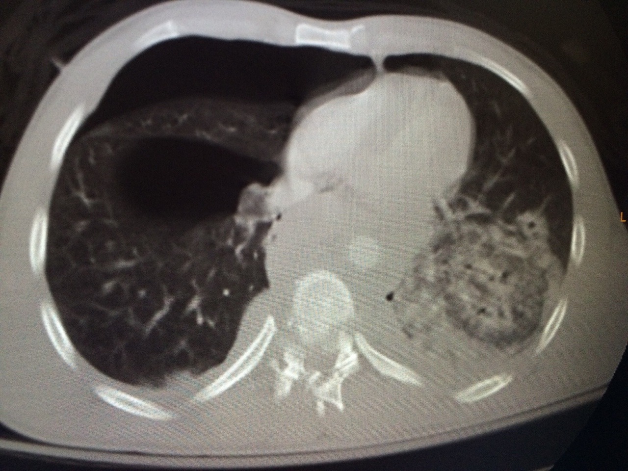 nurseeyeroll:  myradfindings:  easily the worst thoracic spine fracture I have ever