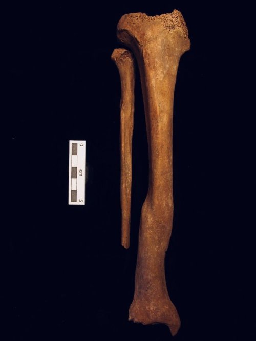 theolduvaigorge: “…a picture of a healed spiral fracture, right tibia and fibula. Middl