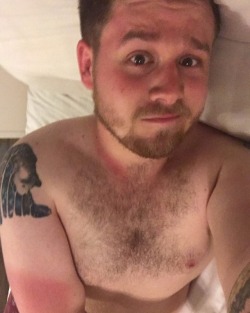 thelonelyhobbitcub:That sunburn/ tan-lines