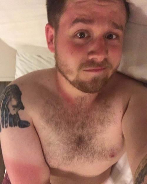 thelonelyhobbitcub:That sunburn/ tan-lines though 🙈🔥😅 #scruffyhomo #selfportrait #sunburn #tanlines #shirtlessselfie #inkedguys #rudolph #donotlike #redandsore