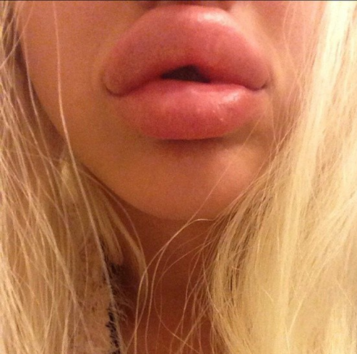 sbmorphical: Have some ridiculously huge lips. As far as I know, these are unmanipulated photos.