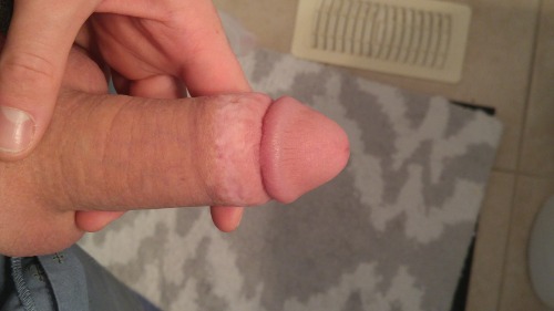 Porn osiris8x6:  Adult circumcision scar 8 weeks photos