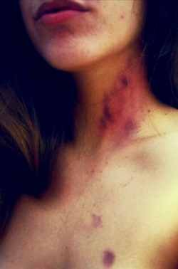 scrambledeggsandwobblylegs:  My hickeys