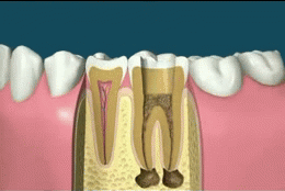 sixpenceee:ROOT CANAL PROCEDUREA root canal is a procedure done to help repair a