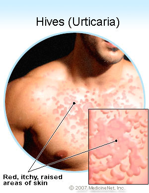 Hives allergic reaction skin rash