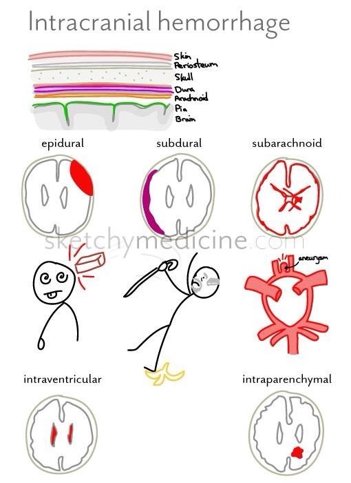 nurseshustle:  Via sketchymedicine.com 
