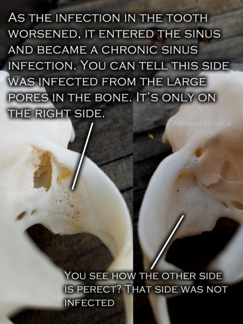 therestlesswitch: formaldehund: arsanatomica: Bones are interesting because you can sometimes read t