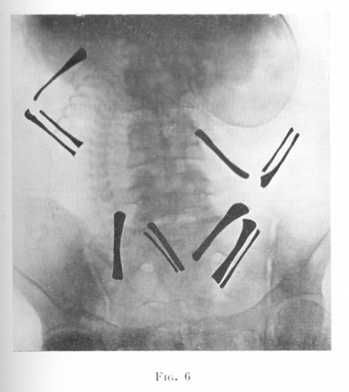 Fluoroscopic images of fetuses in utero, with position of arm and leg bones highlighted, c.1932. Flu