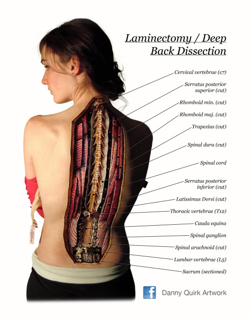 Newest dorsal doodle… Back Dissection / Laminectomy revealing the spinal cord, and deep struc