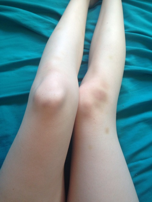 blooodelf:  I bruise so easily