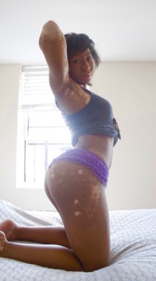 blackgirlsinterracial:  This girl with vitiligo is showing herself off bravely.  She’s still sexy and knows it.