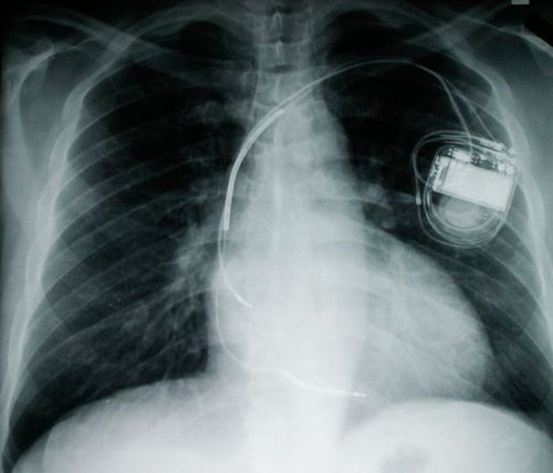 An X-ray image of an implanted pacemaker A pacemaker is a medical device that uses electri
