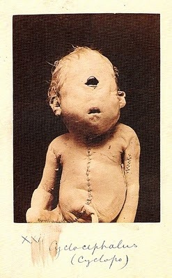 “Cyclops baby”…one eyed baby. These never