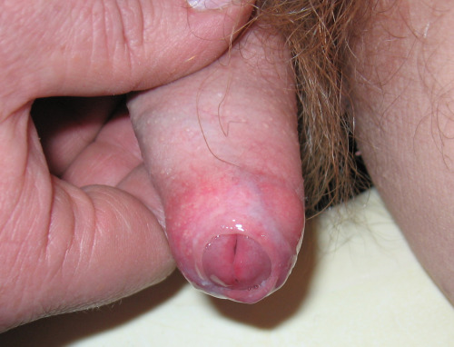 gallardocolour:My small cocks tight foreskin.