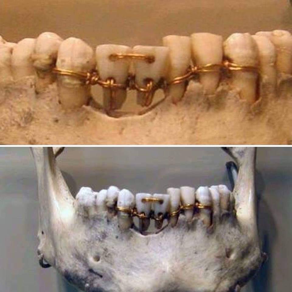 historyarchaeologyartefacts:Ancient Egyptian dental work from 2000 BCE [960 x 960]
