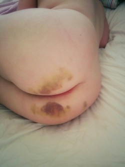 sweetpea-the-sub:  littleone-underdevelopment:  I love the changing colour of bruises, even though it makes me sad that they’ll soon be gone.  I like how the bottom bruise looks let a set of trees with yellowy grass. I see weird things in my bruises.