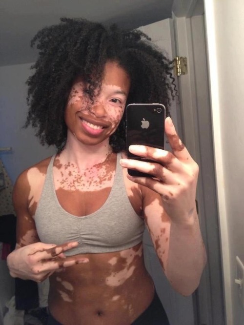 johnwatsonspornstache:bongmeblazer:brittanybatman:veriknawty:Vitiligo is fascinating. Each person ha