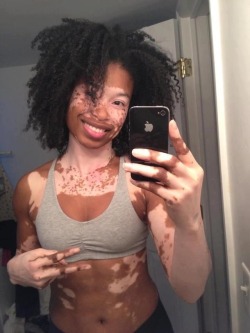 allaboardthen0petrain:Vitiligo is beautiful. All it is, is built in war paint  