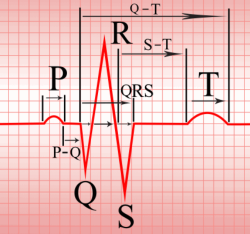 inrnsanity:  EKG tip:  Don’t get in the habit of saying “QRS,” say “Ventricular Complex” or “V Complex,” which consists of three parts: the Q, R, and S waves. I was really annoyed when I had to relearn this.  Once you get into more advanced