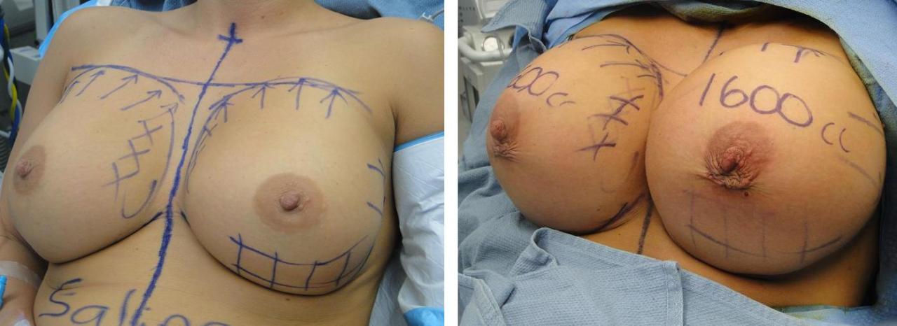 Breast Enhancement Surgery is the fastest way to grow your breasts (albeit the most