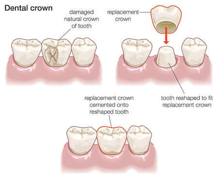 Dentures that look natural teeth