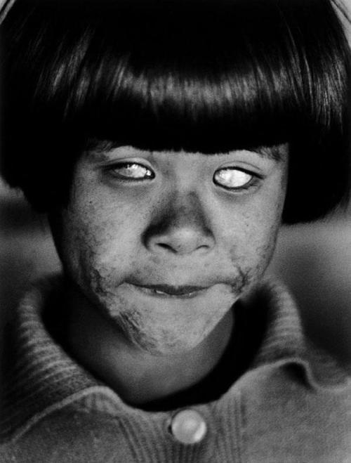 A child blinded by the atomic bomb at Hiroshima, 1945.