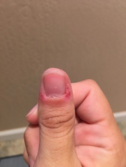 kdkorz10211:  The current state of my thumb.