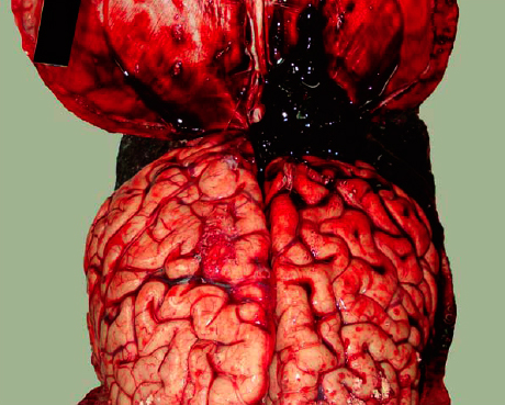 smellslikecadaverine:  Acute subdural hematoma secondary to blunt head trauma. 
