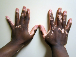 wrotten:  Vitiligo of the hand in a person