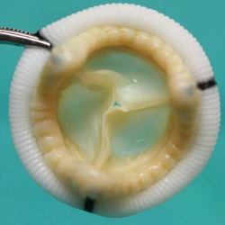 medicinethings:Prótesis valvular cardíaca - Heart valve prosthesis 