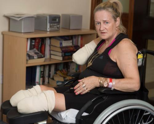 UK TV personality Annie Caddis who lost her legs below knee and arm at/above elbow to infection.