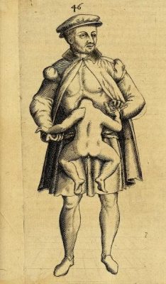 scienceyoucanlove:  A gentleman with a parasitic twin from ‘Monstrorum historia memorabilis’ by Johannes Schenk von Grafenberg, 1609. source  