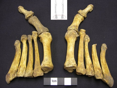 This week MOLA osteologists have been studying the feet of a 19th-century Londoner, a woman who died