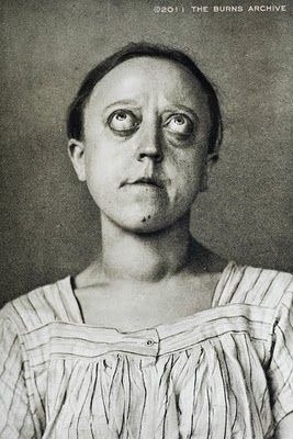 theoddcollection:  Graves’ disease (or Flajani-Basedow-Graves disease) is an autoimmune