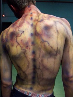 fierocity:  imyobabyy:  lady-medic:  In case anyone wanted to know what a lightening strike can do to the body- given that they survive.  Woah  I’ve reblogged this before but I didn’t know it was from a lightning strike. That’s insane. 