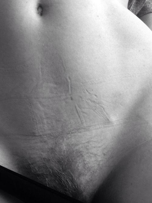 XXX the-naked-me:  lower marks see the rest of photo