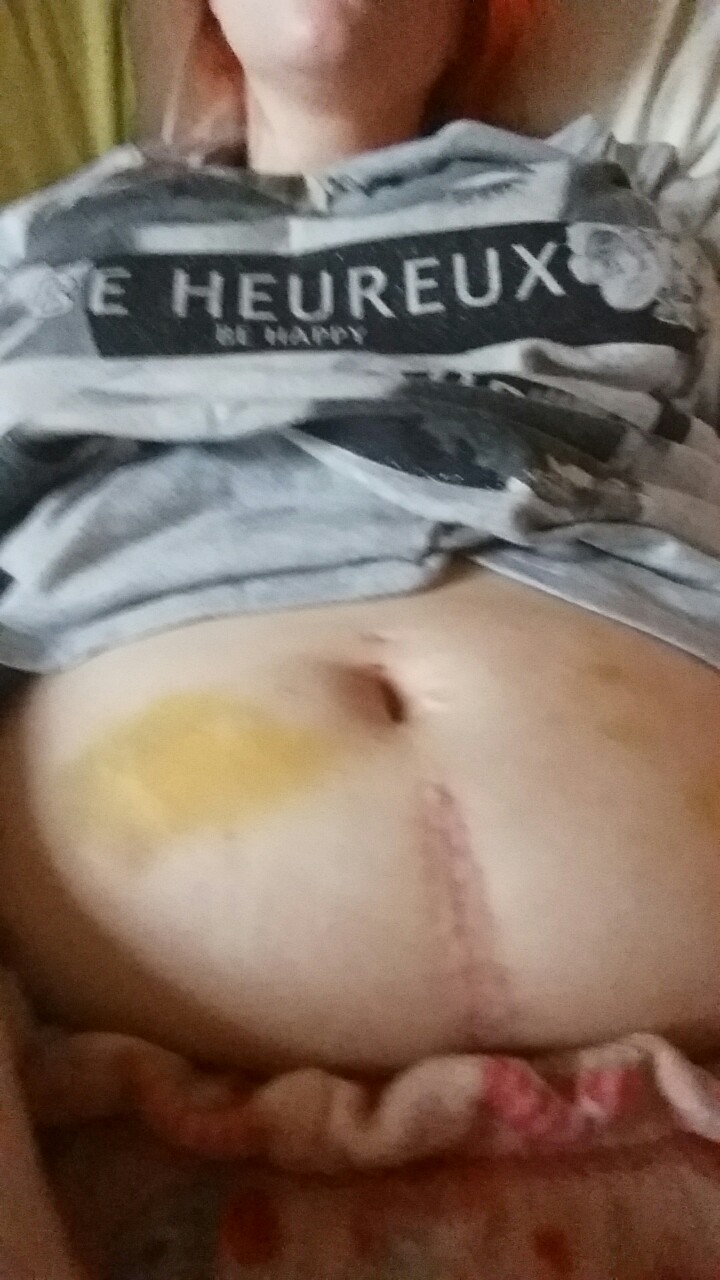 ursularubenesque:  Okay so don’t say I didn’t warn you! This is my stomach tonight,